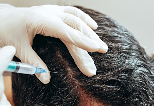 Косметолог о пересадке волос: это не является лечением