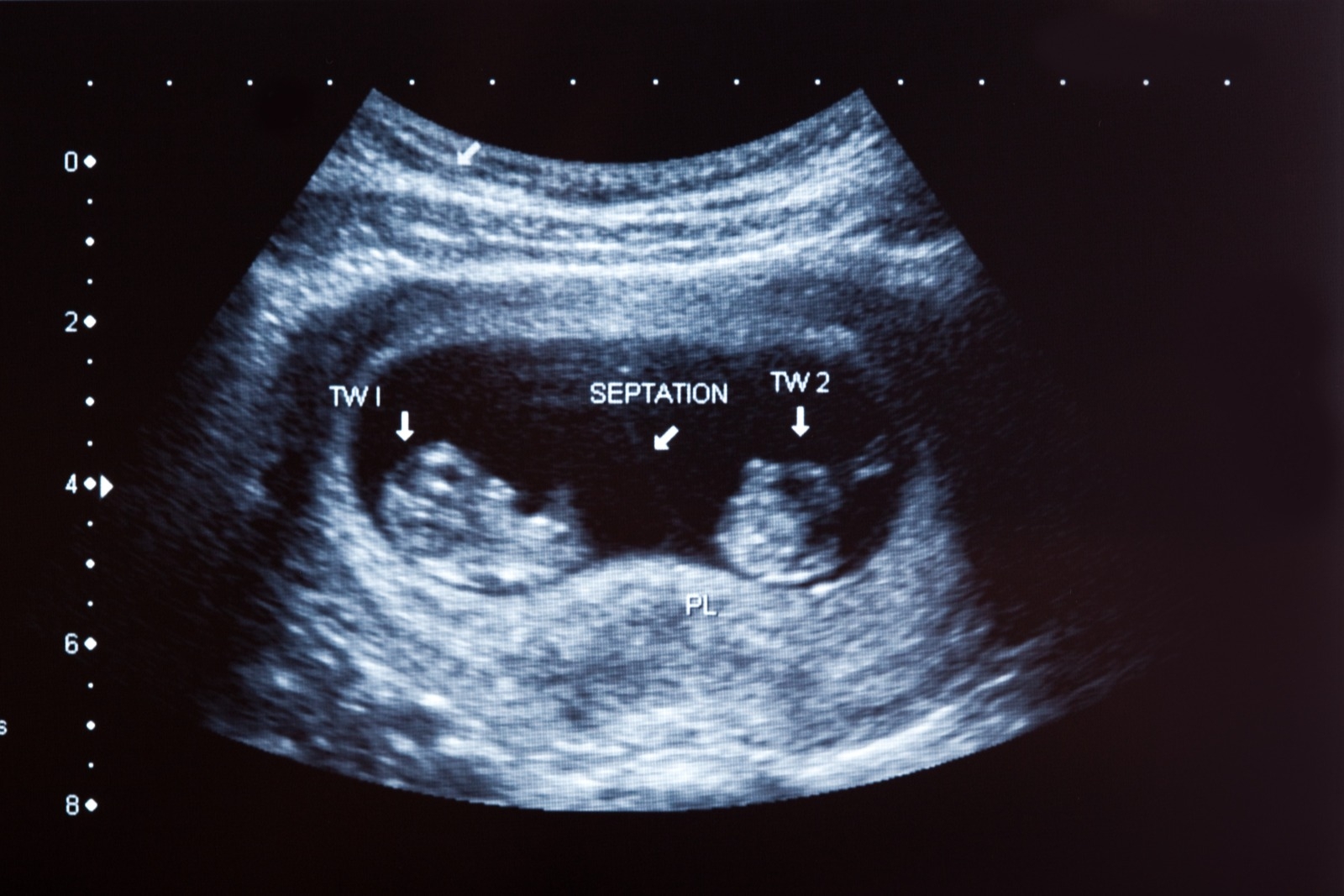Гинеколог: аборты только по ОМС загрузят женские консультации